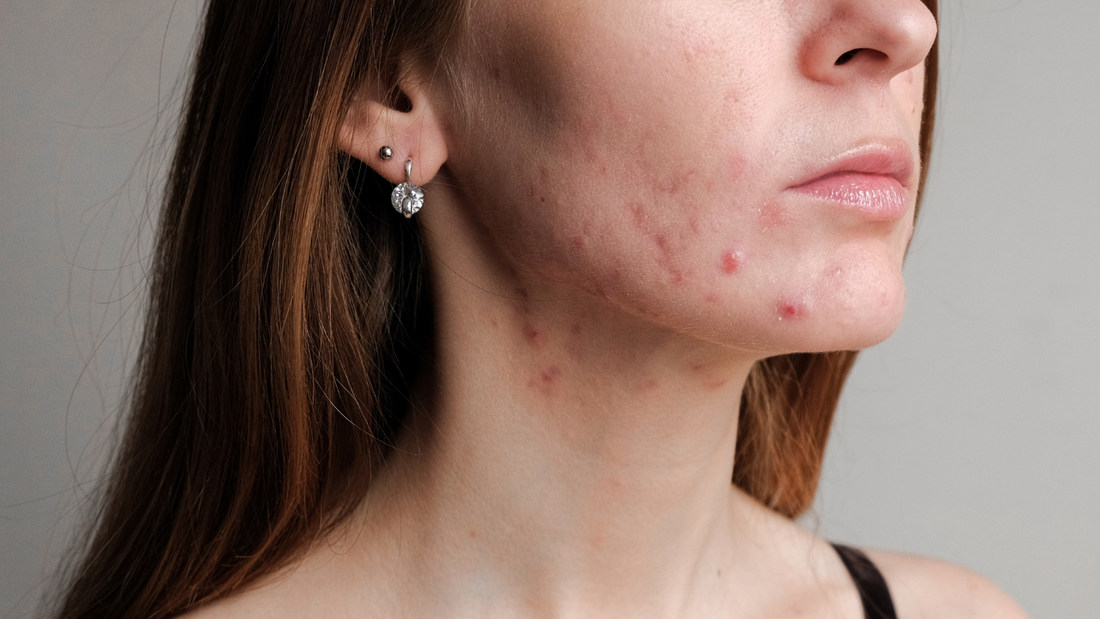 Så hanterar du hormonell akne – tips och behandlingar som fungerar